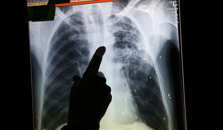 Public Health Threat: 16 Refugees In Colorado Diagnosed With Tuberculosis