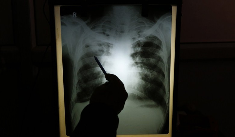 CDC: Tuberculosis Cases Spiking in USA Since 2022. What Else Has Spiked in America Since Then?