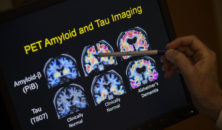 The Science of an Alzheimer's Disease Theory Was Questioned. The Results Could Be Devastating. 