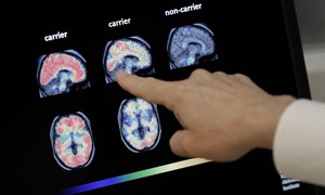 It Looks Like We've Made a Big Step in Combating Alzheimer's