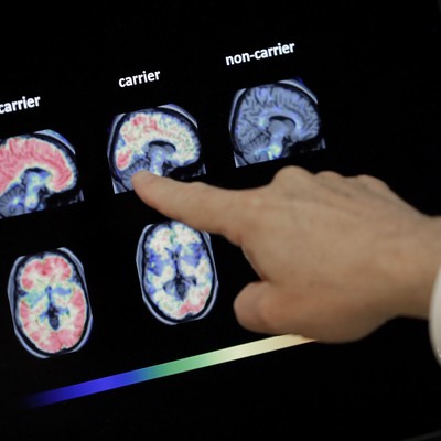 It Looks Like We've Made a Big Step in Combating Alzheimer's