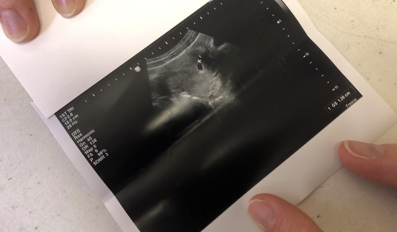The Abortion Pill Reversal Planned Parenthood Doesn't Want to Talk About