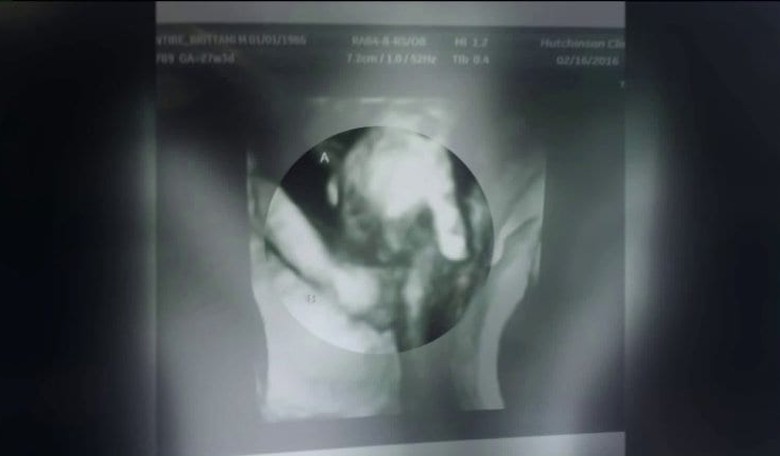 Touching Ultrasound: Baby Dying in the Womb Comforted by Twin Sister