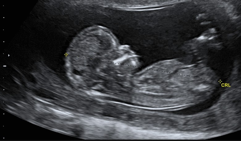 Hillary & Trump Dueling Abortion Gaffes Clarify Controversial Issue