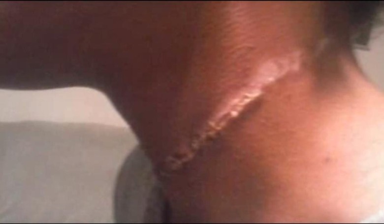 Black Student Gets Rope Burn Around Her Neck on a School Trip
