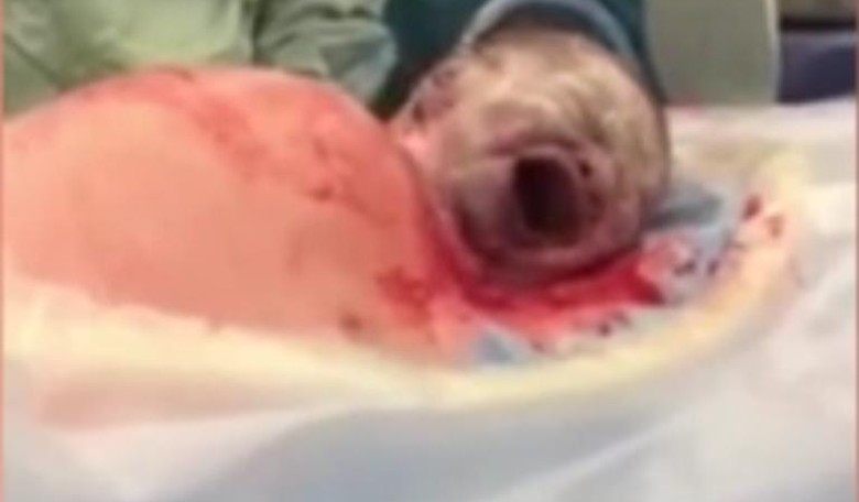 Startling Video Shows Baby Crawling Out of Mother's Womb During C-section