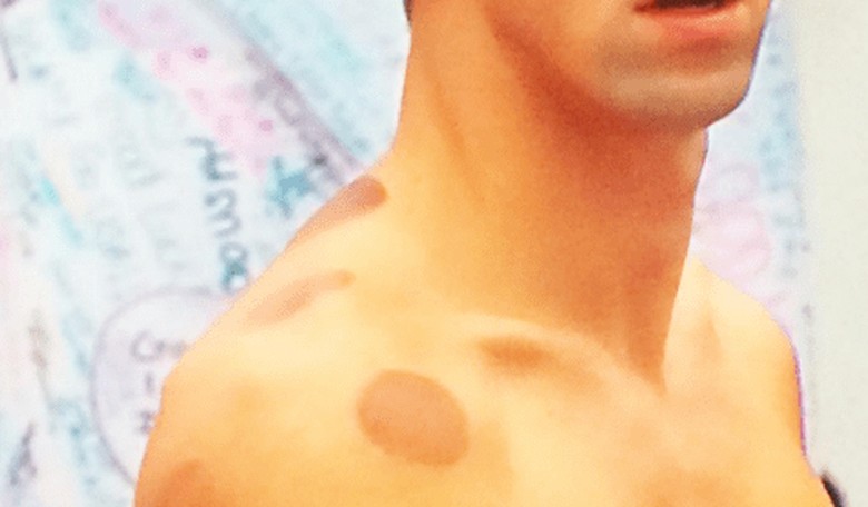 The Internet Is Freaked Out About Those Weird Purple Spots All Over Michael Phelps' Body