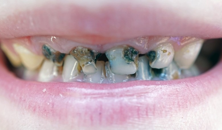 Why Are Preschoolers in Australia Having Mouthfuls of Rotten Teeth Removed?