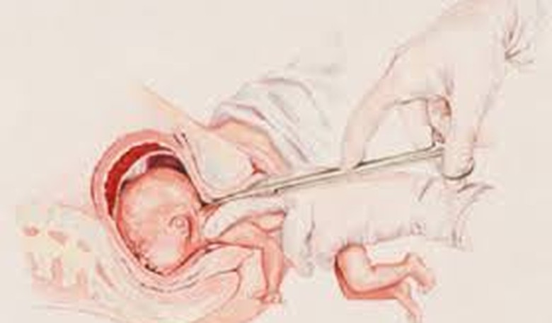 Kentucky Abortion Law Struck Down by a Federal Judge