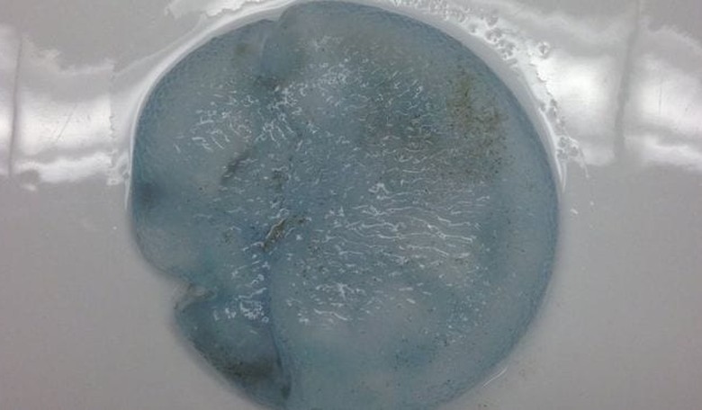 Man's Breast Implant Revealed to be a Jellyfish