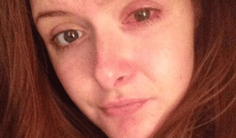 Woman Rips Off Part of Her Cornea After Leaving Contacts in Too Long