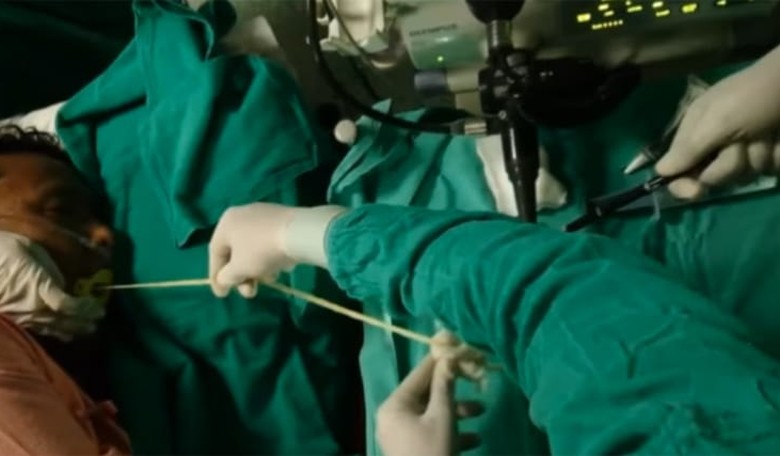 Parasite Horror: Six-Foot Tapeworm Pulled Out of Man's Mouth