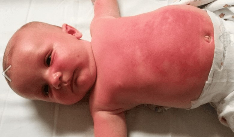 Mother: Sunscreen Gave My Baby a 'Horrible Rash/Burn' That Landed Him in the Hospital