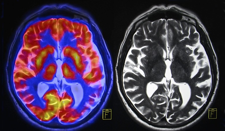 Newborn Brain Might Indicate Risk of Mental Disorders Later in Life