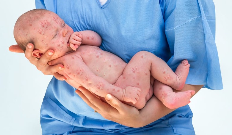 Expert Warns: Measles Outbreaks Are Coming in 2017