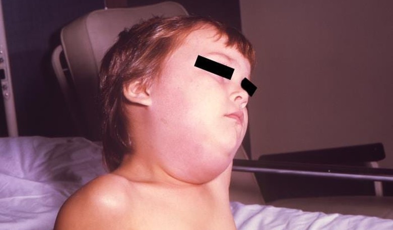 Mumps Making a Comeback in 2017 as Vaccination Rates Decline