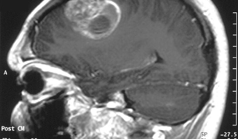New Treatment Offers Hope for Patients with Glioblastoma Tumors