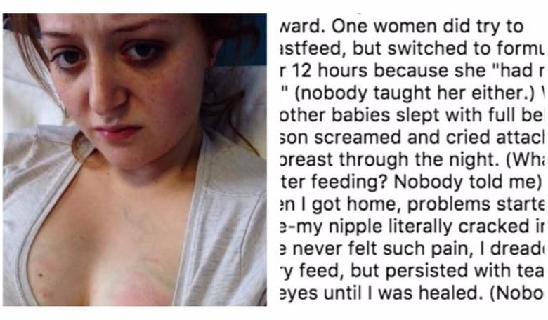 Breastfeeding Mom Shares Mastitis Horror Pics on Instagram