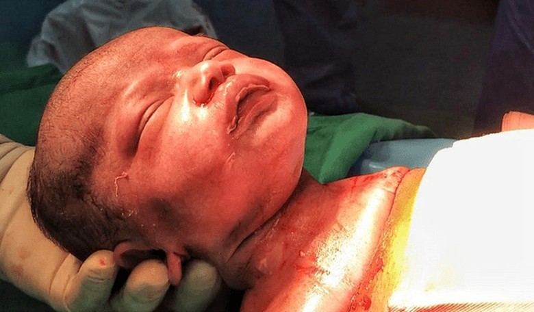 Watch as a Baby Wriggles Out of Mother's Womb During a 'Gentle' C-Section