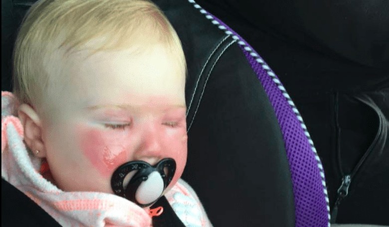 Mom Warns About Sunscreen After Her 14-Month-Old Lands in the ER