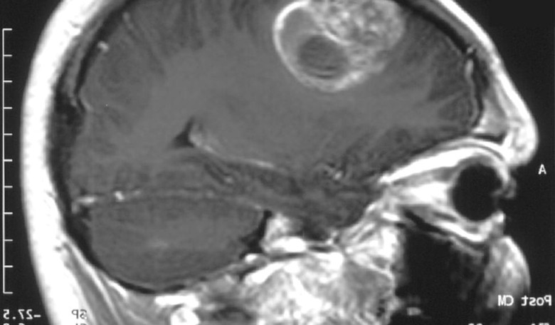 Why McCain's Glioblastoma Will Be the Fight of His Life