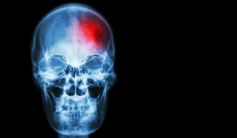 STUDY: Millennials Are Suffering an Alarming Number of Strokes