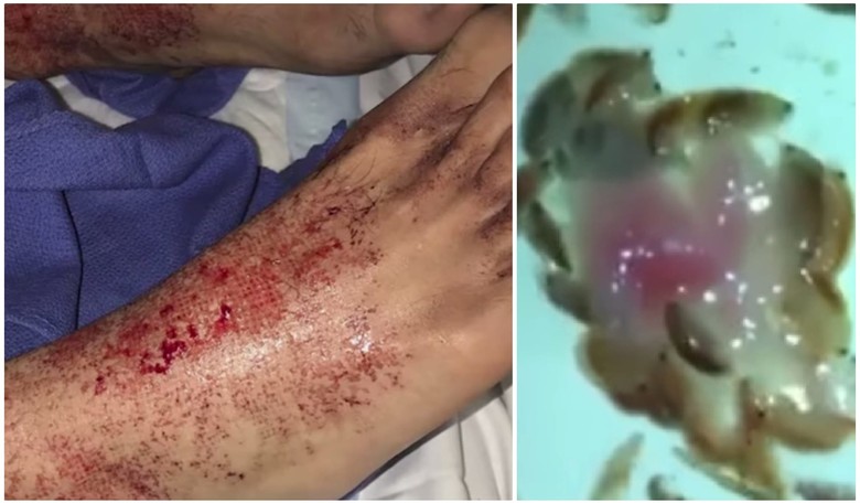 Mysterious Flesh-Eating Sea Creatures Munch on Australian Teen's Legs