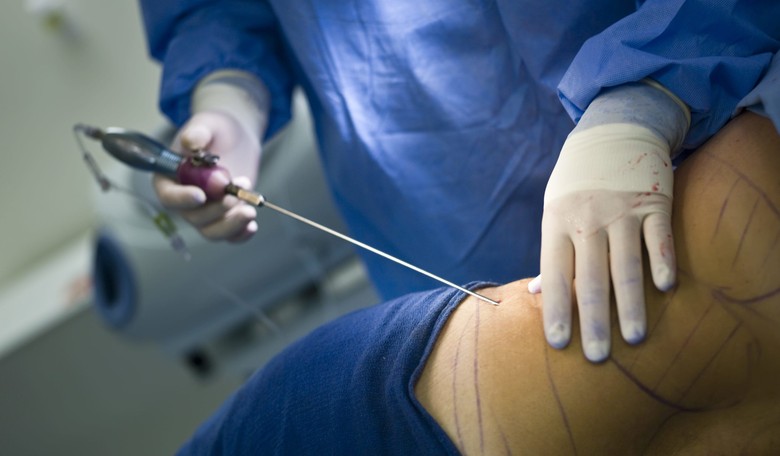 Liposuction Nightmare: Woman Placed on Ventilator after Fat Globule Enters Bloodstream