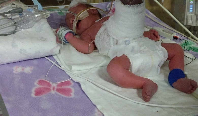 Miracle Baby Overcomes Being Born with Intestines Outside of Her Body