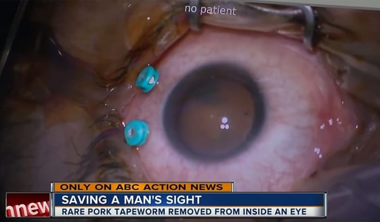 Brain-Eating Parasitic Tapeworm Embeds Itself in Florida Man's Eye