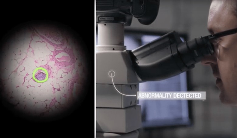 Google AI Microscope Can Already Detect Breast Cancer, Prostate Cancer