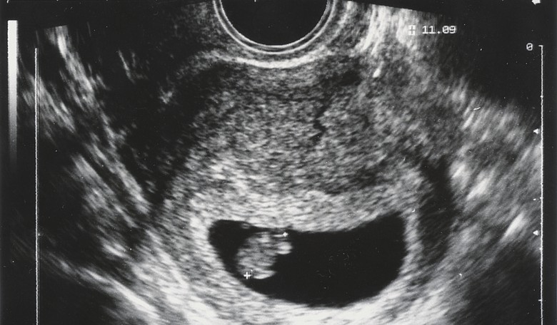 Iowa Passes Bill Banning Abortion After Fetal Heartbeat Detected