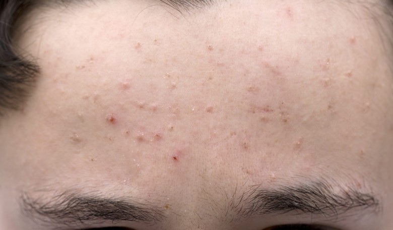 'Pimples Are In.' Body Positivity Movement Embraces Acne