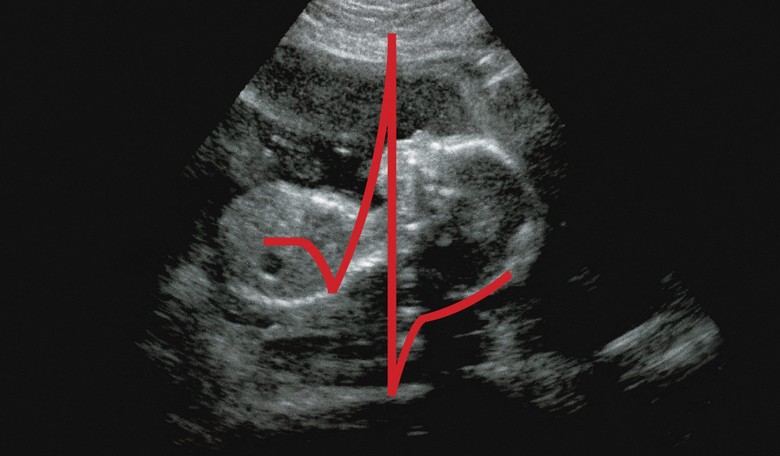 Georgia Legislature Passes 'Fetal Heartbeat' Bill