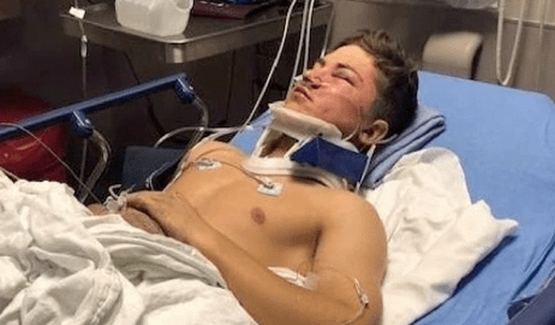 Teen Who Fell 50 Feet from a Bridge Warns about the Dangers of Selfies