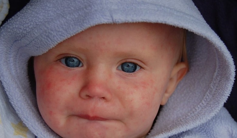 Measles on the Move—Outbreak Spreads Beyond New York
