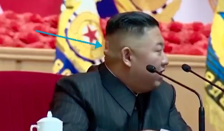 That Mysterious Kim Jong-un Bandage: Now What's Wrong With Him?