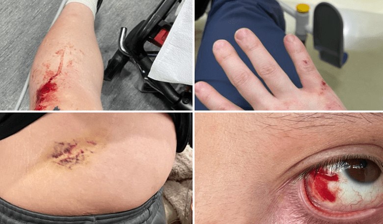 Andy Ngo Confirms Violent Antifa Attack and Shares the Harrowing Details