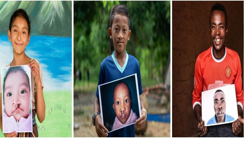 Feel-Good Friday: Celebrate World Smile Day and Help Restore Cleft Palates