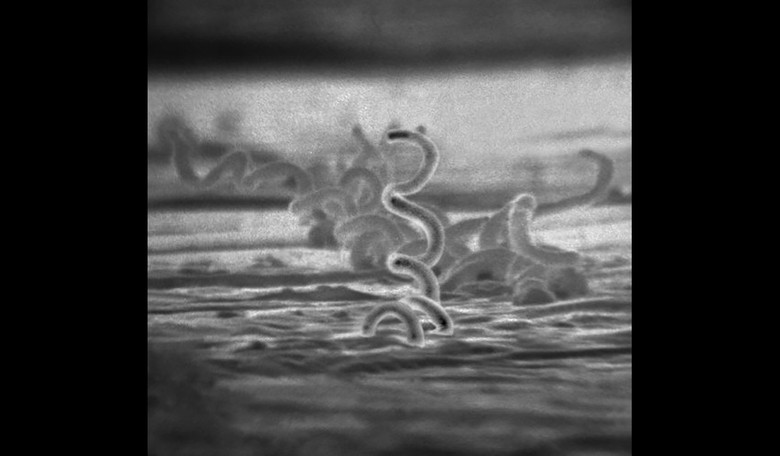 U.S. Sees Record Syphilis Cases - CDC Blames Funding Cuts