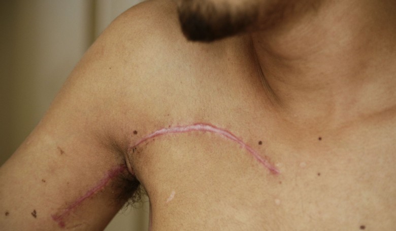 'Shoulder Width Reduction Surgery': The Latest 'Transgender' Aesthetic Mutilation Fad