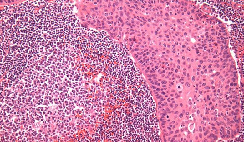 American Cancer Society Issues New Screening Recommendations for 'Individuals With a Cervix'